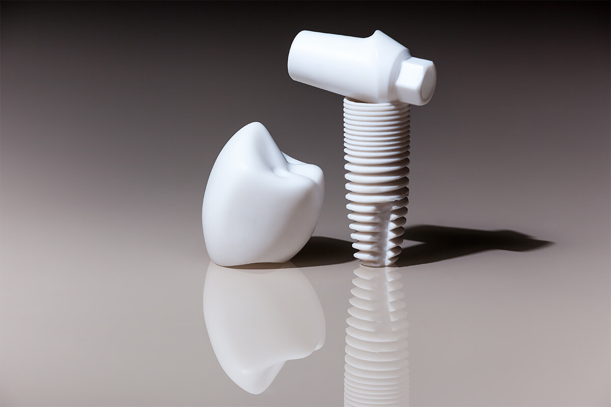 Ceramic Dental Implants in Nashville TN Area