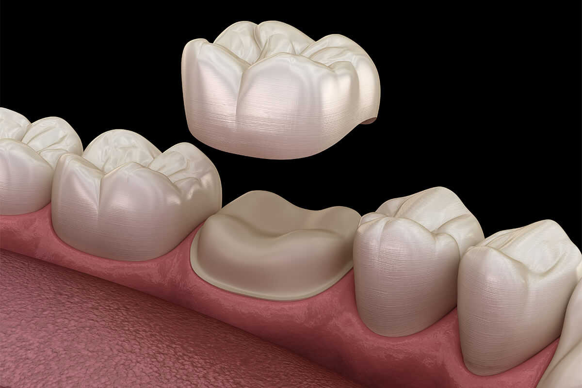 Same-day Crowns for Front Teeth in Franklin TN Area