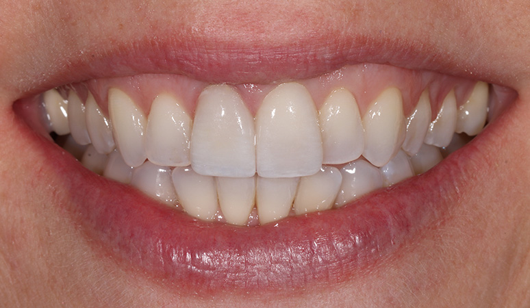 Amber - Veneers Before and After Case After Image