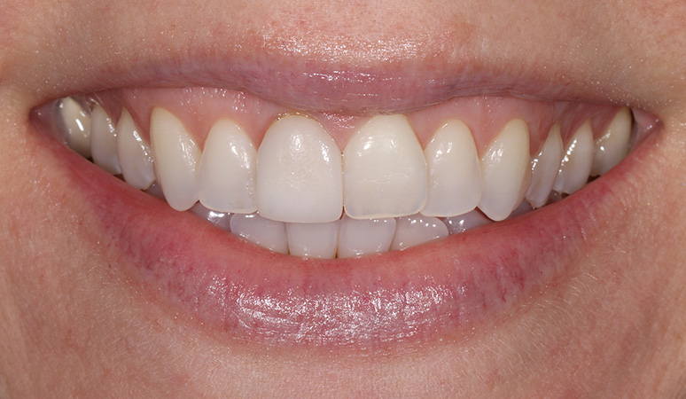 Macey - Veneers Before and After Case Before Image