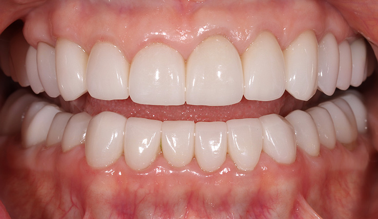 Connie Kimbro - Full-Mouth Rehabilitation Before and After Case After Image