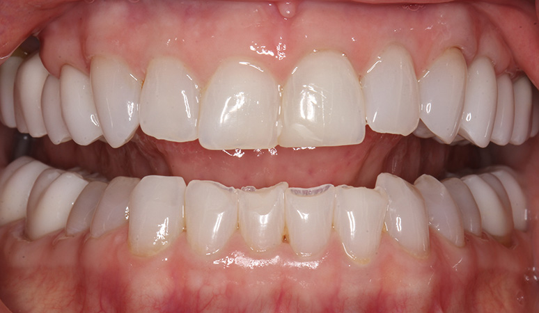 Connie Kimbro - Full-Mouth Rehabilitation Before and After Case Before Image