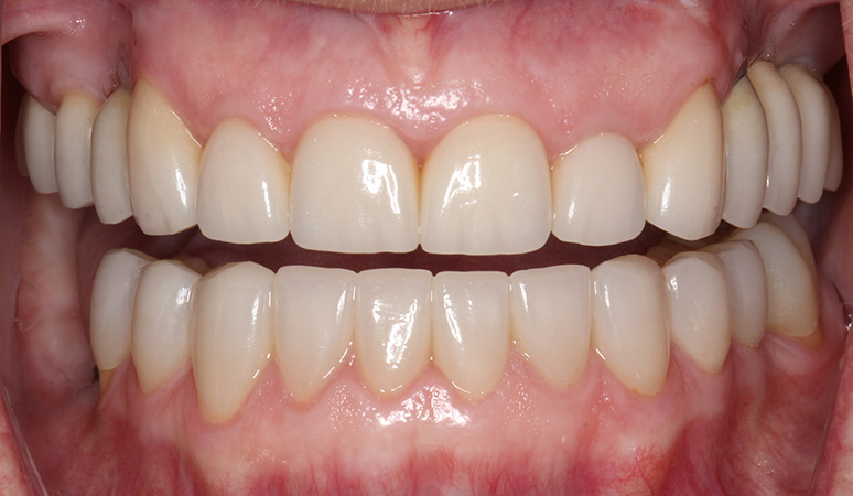 Vonda - Full-Mouth Rehabilitation Before and After Case After Image
