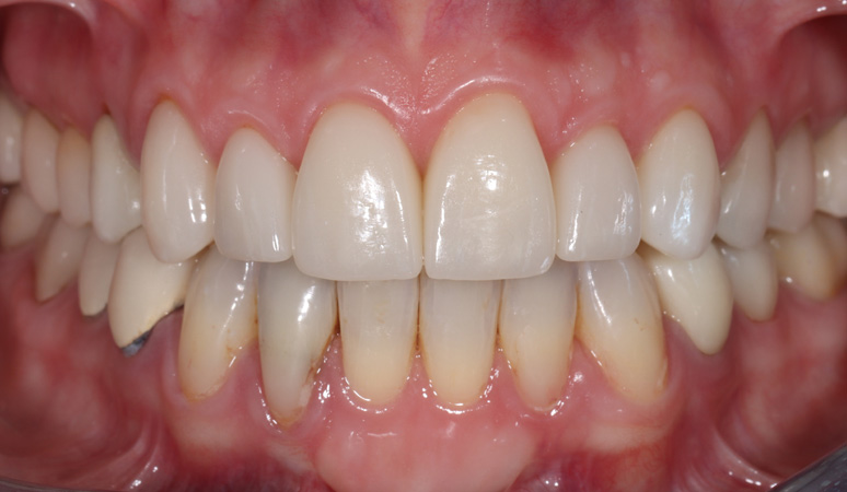 Macey - Veneers Before and After Case After Image