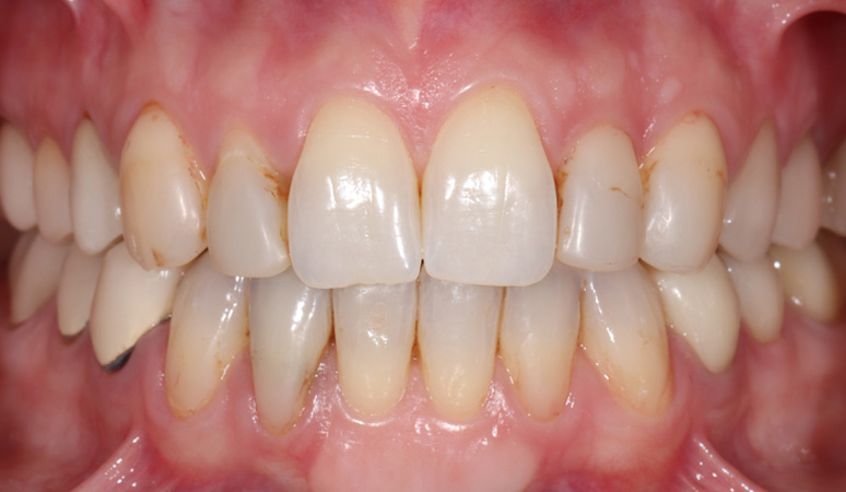 Macey - Veneers Before and After Case Before Image