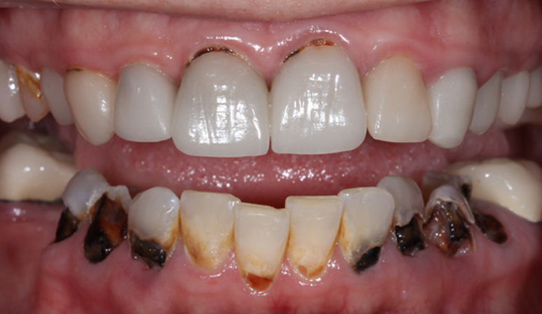 Ashley - Dental Implants Before and After Case Before Image