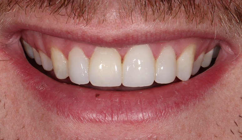Baylor - Smile Makeover Before and After Case Before Image