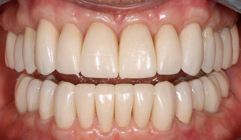 Brad - Full-Mouth Rehabilitation Before and After Case After Image