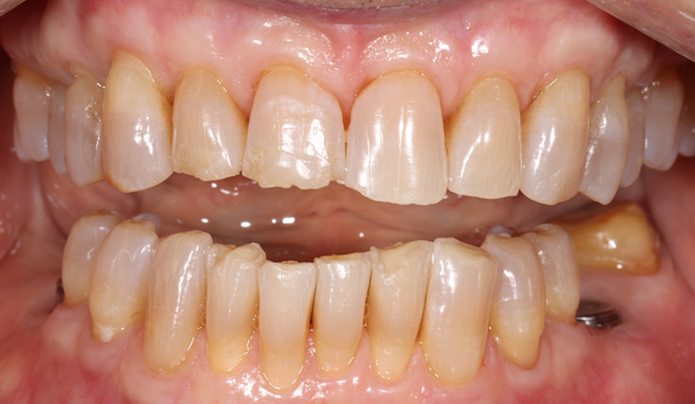 Brad - Full-Mouth Rehabilitation Before and After Case Before Image