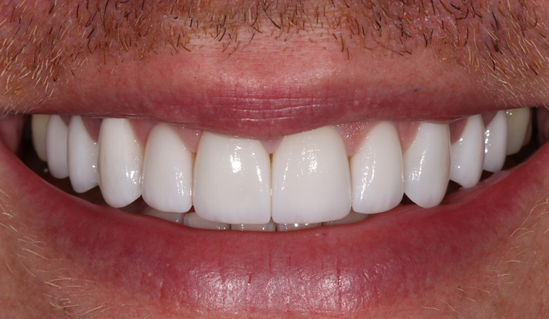 Cory - Veneers Before and After Case After Image
