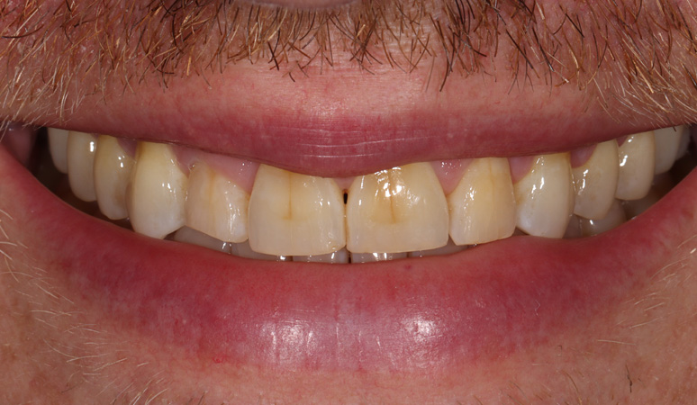 Cory - Veneers Before and After Case Before Image
