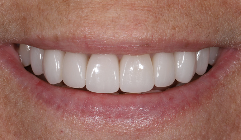 Elle - Veneers Before and After Case After Image