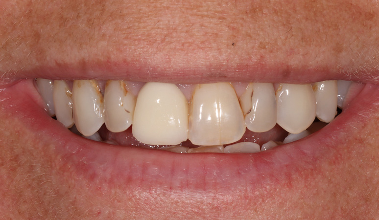 Elle - Veneers Before and After Case Before Image