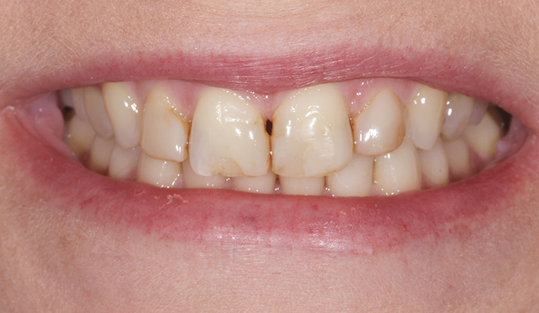 Karen - Smile Makeover Before and After Case Before Image