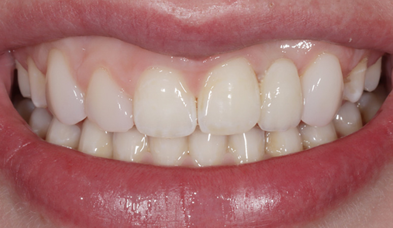 Mabel - Smile Makeover Before and After Case After Image