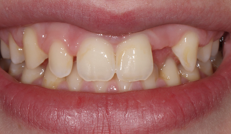 Mabel - Smile Makeover Before and After Case Before Image