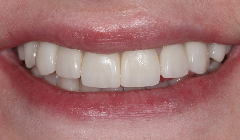 Maggie - Smile Makeover Before and After Case After Image