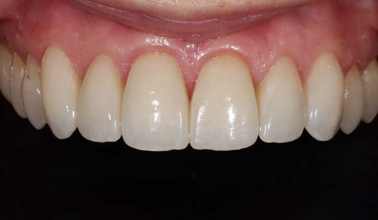 Nadia - smile makeover Before and After Case After Image