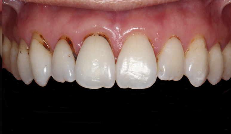 Nadia - smile makeover Before and After Case Before Image