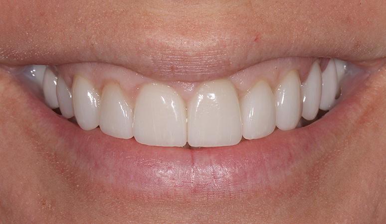 Nicole - Veneers Before and After Case After Image