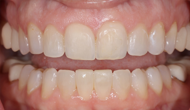Nicole - Full-Mouth Rehabilitation Before and After Case Before Image