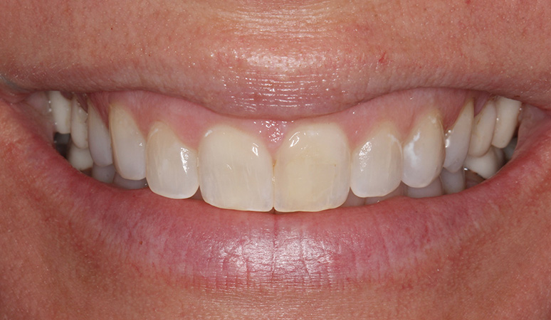 Nicole - Veneers Before and After Case Before Image