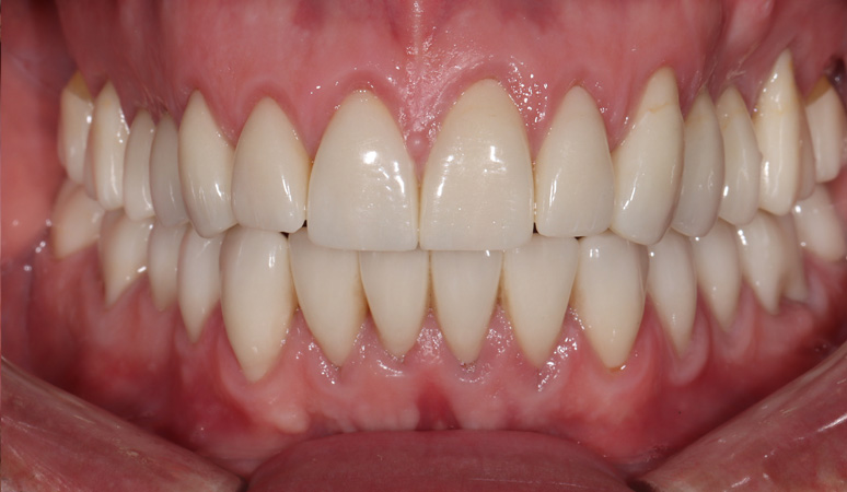 Scott - Full-Mouth Rehabilitation Before and After Case After Image