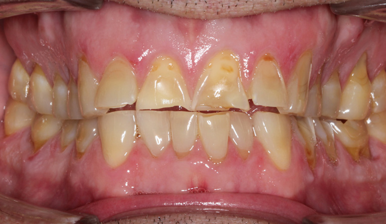 Scott - Full-Mouth Rehabilitation Before and After Case Before Image