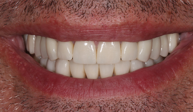 Scott - Smile Makeover Before and After Case After Image