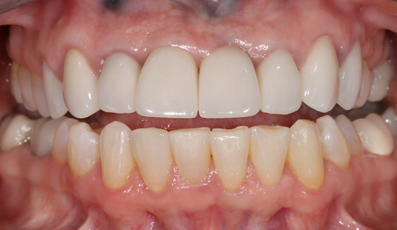 Sheila - Dental Implants Before and After Case After Image