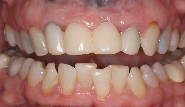 Sheila - Dental Implants Before and After Case Before Image