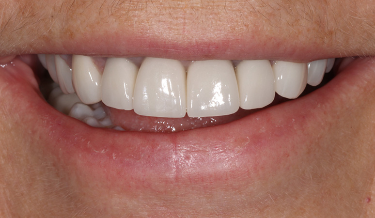 Sheila - Smile Makeover Before and After Case After Image