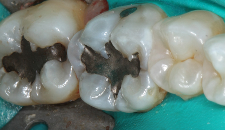 Amalgam Removal, Case-1, - Before and After Case Before Image
