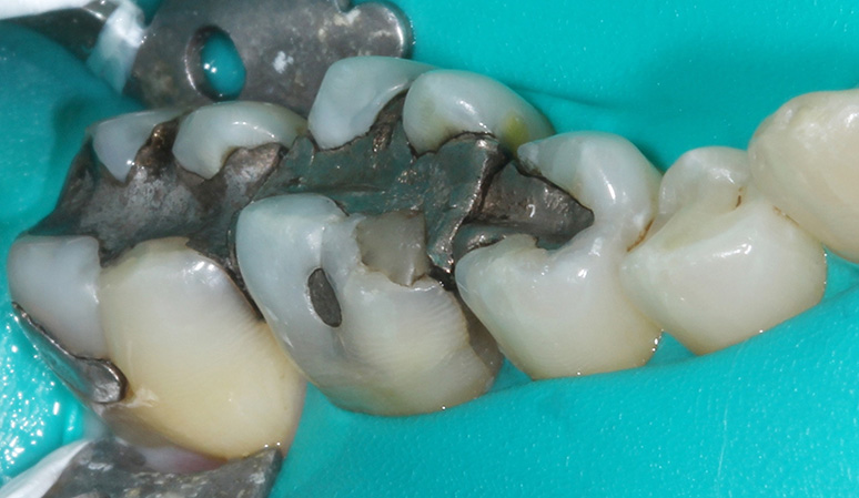 Amalgam Removal, Case-2, - Before and After Case Before Image