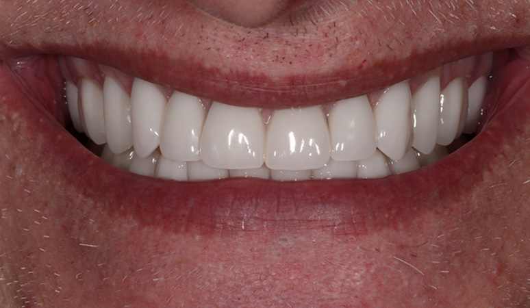 John - Dentures Before and After Case After Image