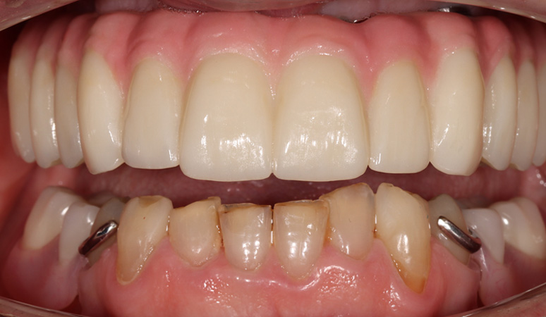 Kevin - Dental Implants Before and After Case After Image