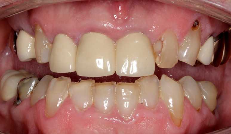 Kevin - Dental Implants Before and After Case Before Image