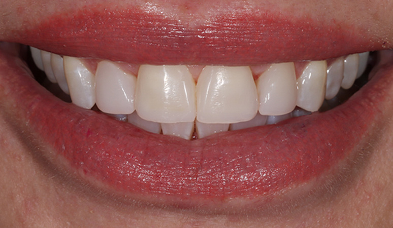 Sherry - Veneers Before and After Case After Image