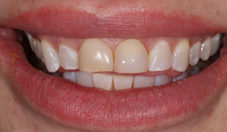 Sherry - Veneers Before and After Case Before Image