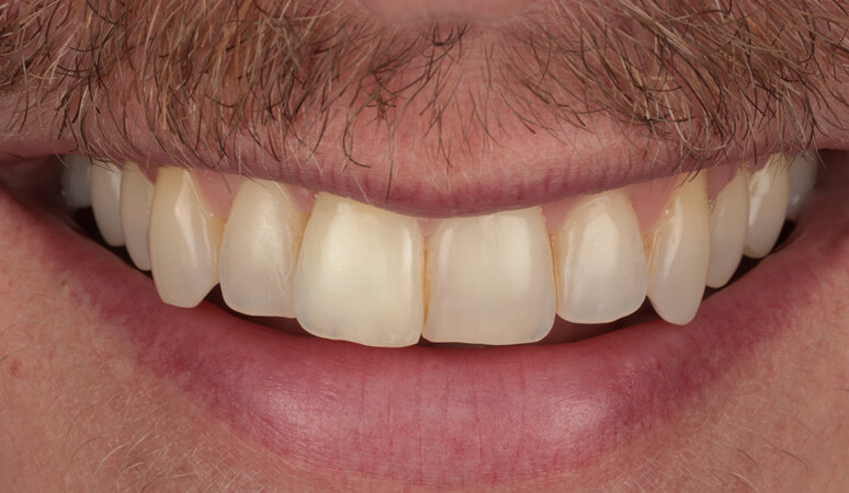 Brian - Teeth Whitening Before and Before Results, After Image