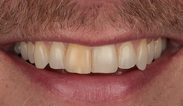 Brian - Teeth Whitening Before and Before Results, Before Image