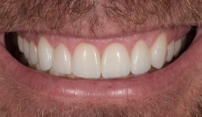 Clay - Veneers Before and After Results, After Image
