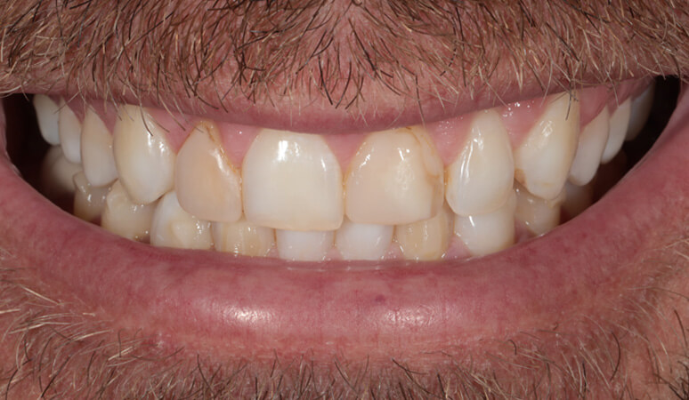 Clay - Veneers Before and After Results, Before Image
