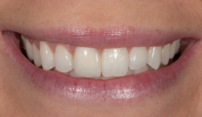 Madeline - Veneers Before and Before Results, after Image