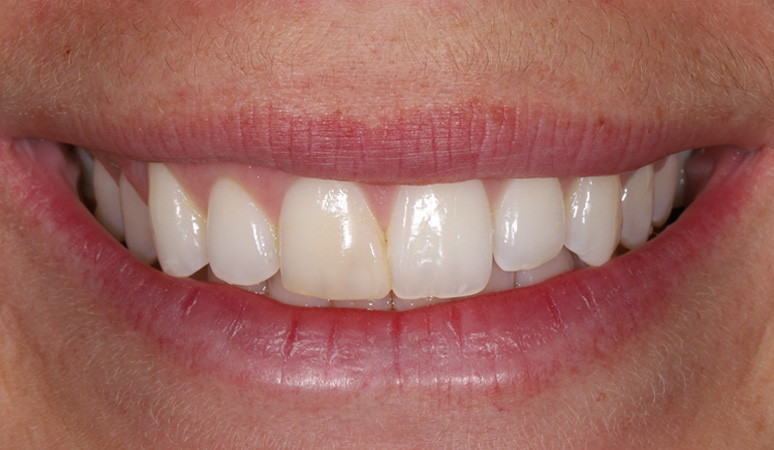 Madeline - Veneers Before and Before Results, Before Image